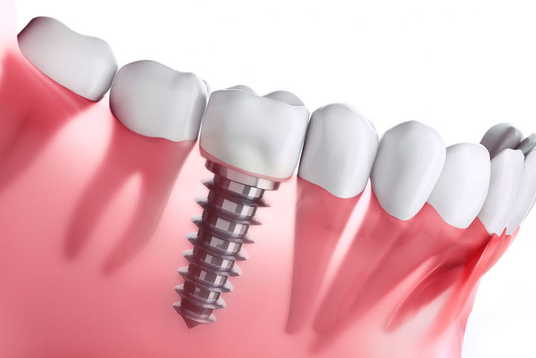 Implant dentaire boulogne billancourt 781x521 1